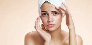 acne management