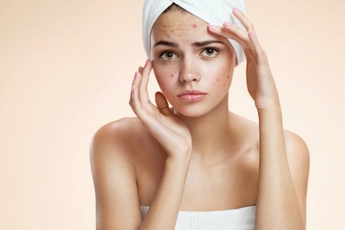 acne management