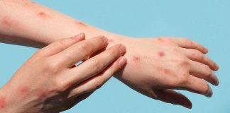 mpox